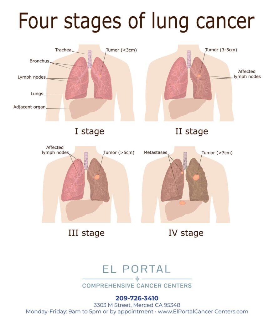 Four Stage of Lung Cancer diagram