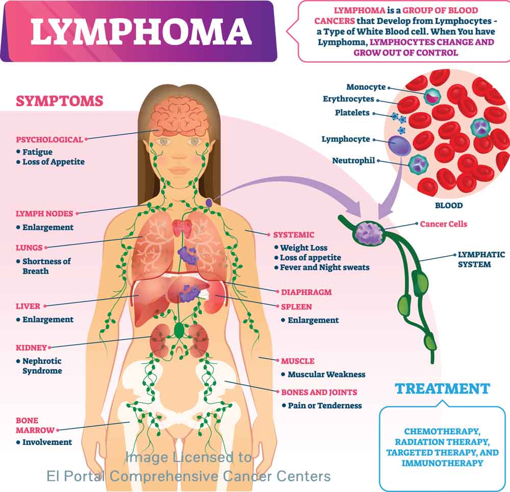 Lymphoma Overview