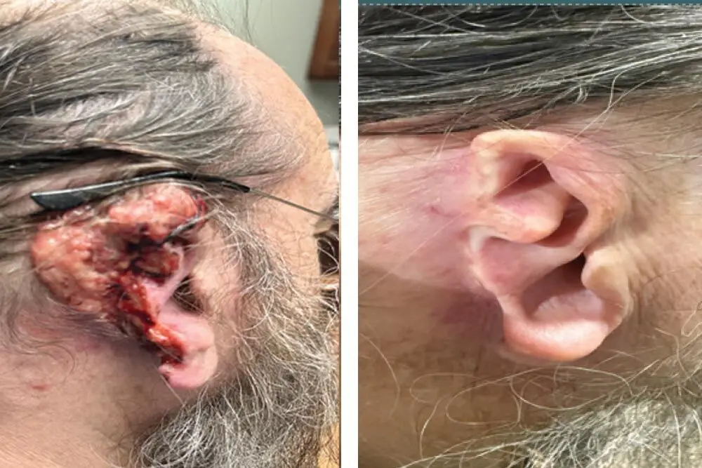 Before and after ear skin cancer surgical repair